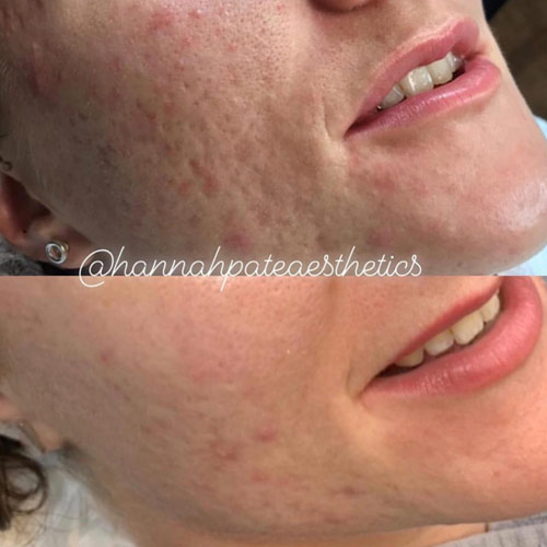 Microneedling Liverpool before and After 1