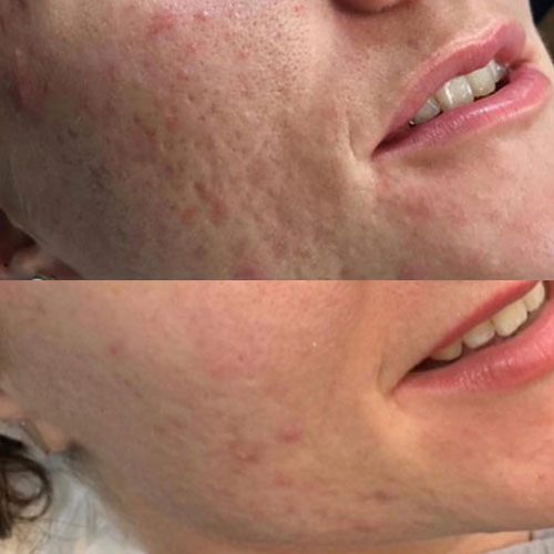 Microneedling Liverpool before and After 1