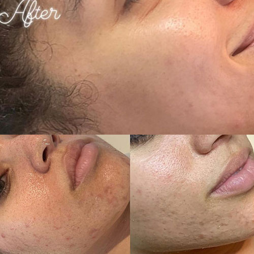 Chemical Skin Peel Liverpool before and After 1