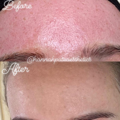 Microneedling Liverpool before and After 2