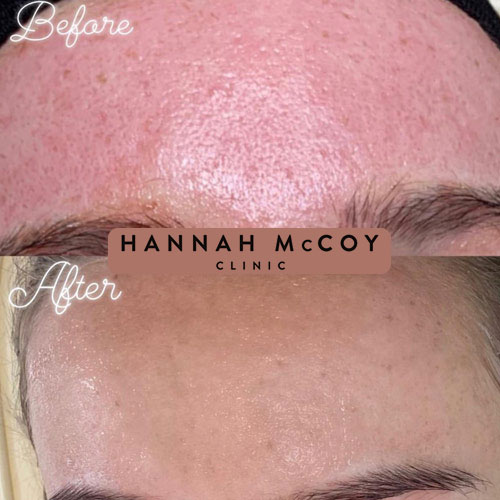 Microneedling Liverpool before and After 2