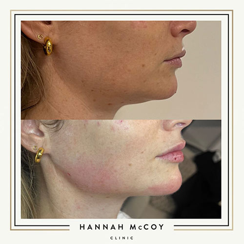 Jawline Enhancement Before and After Liverpool Client 1