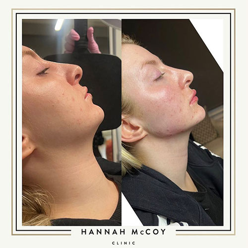 Jawline Enhancement Before and After Liverpool Client 3