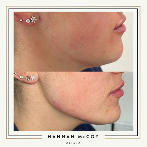 Jawline Enhancement Before and After Liverpool Client 2