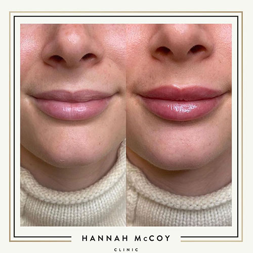 Lip Filler Before and After Liverpool Client 1