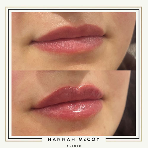 Lip Filler Before and After Liverpool Client 2