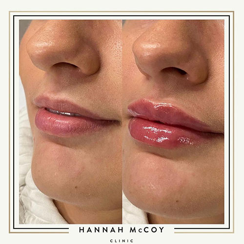 Lip Filler before and After 5