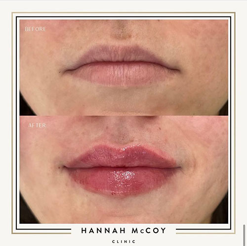 Lip Filler before and After 4
