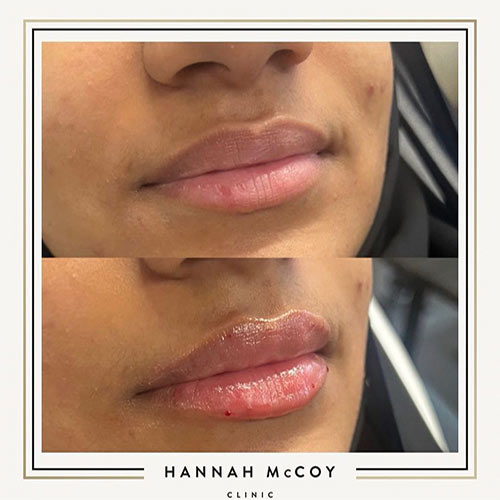 Lip Filler Before and After Liverpool Client 3