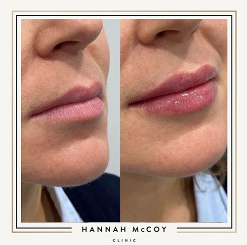 Lip Filler Before and After Liverpool Client 4