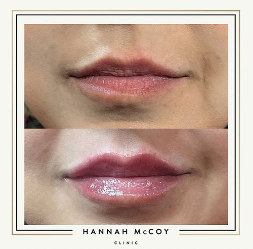 Lip Filler before and After 1