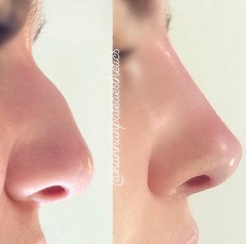 Nose Filler before and After 1