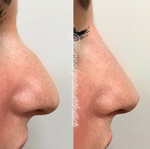 Nose Filler Liverpool Client Pic 3