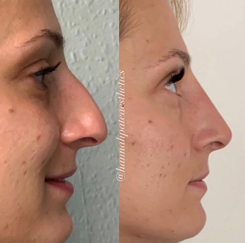 Nose Filler before and After 4