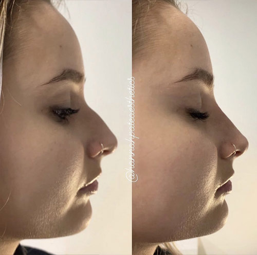 Nose Filler before and After 4