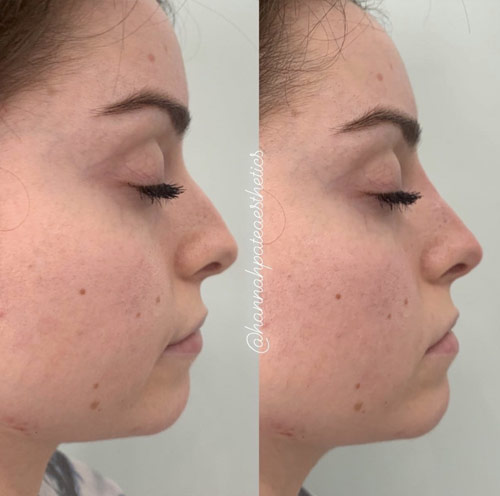 Nose Filler before and After 4