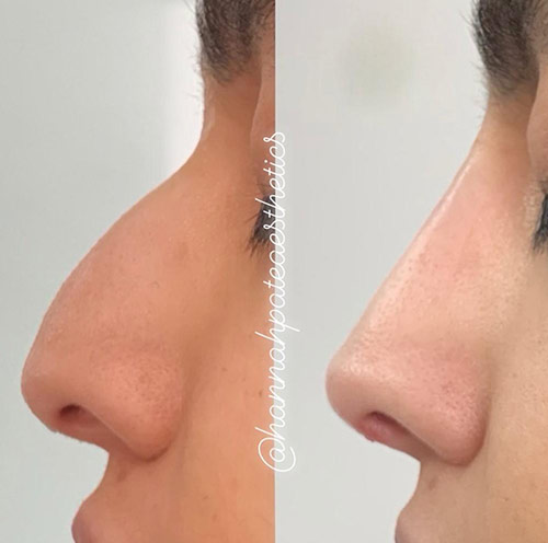 Nose Filler before and After 3