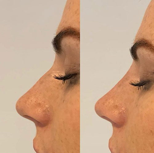 Nose Filler Liverpool Client Pic 3