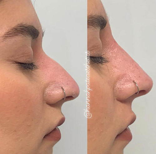 Nose Filler before and After 2