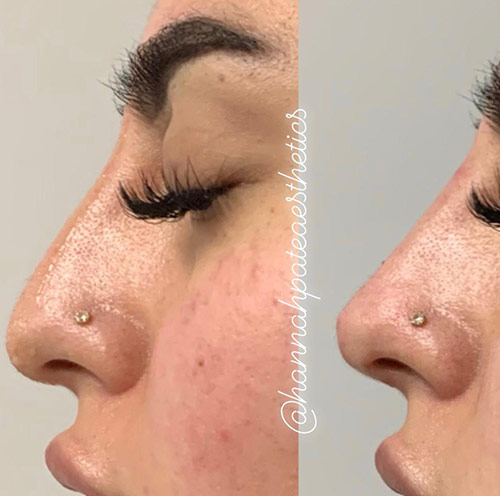 Nose Filler Liverpool Client Pic 1