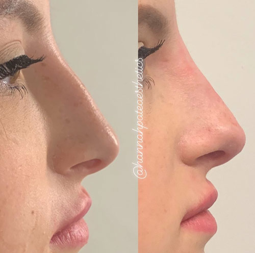 Nose Filler Liverpool Client Pic 3