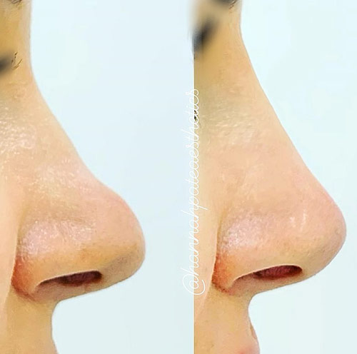 Nose Filler Liverpool Client Pic 1