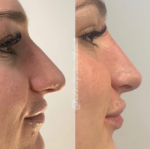 Nose Filler Liverpool Client Pic 3