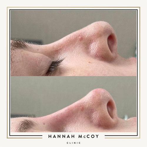 Nose Sculpting Before and After Liverpool Client 4