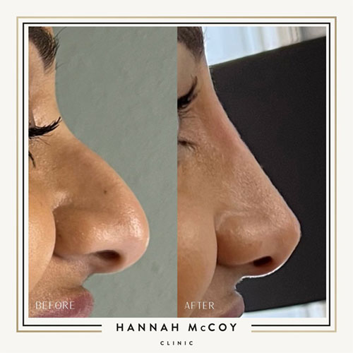 Nose Sculpting Before and After Liverpool Client 2