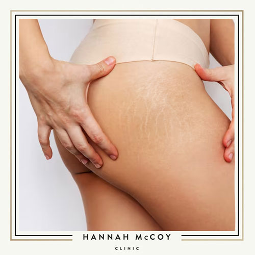 CAN MICRONEEDLING HELP WITH STRETCH MARKS?