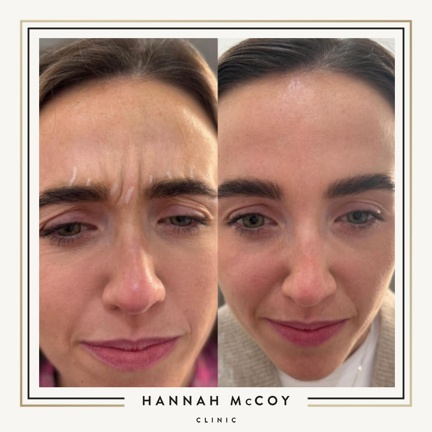 CAN YOU HAVE MICRONEEDLING AFTER BOTOX