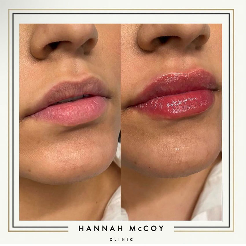 DOES LIP FILLER HURT?