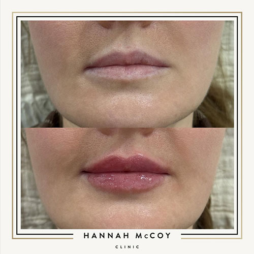 How Long Does It Take for Lip Filler to Settle