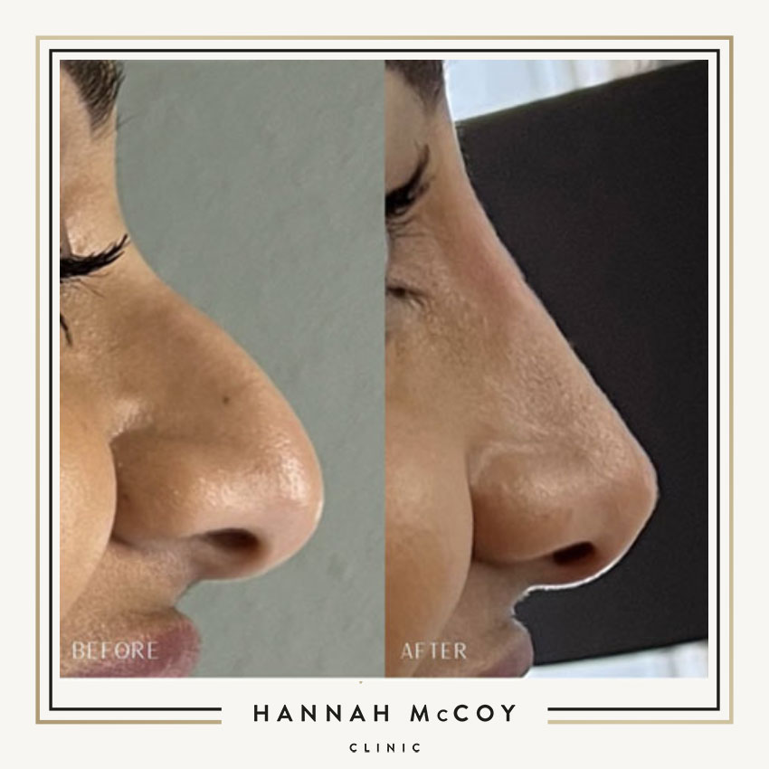 HOW LONG DOES NON SURGICAL RHINOPLASTY LAST?