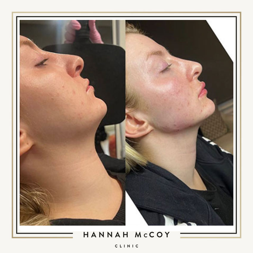 HOW TO GET A BETTER JAWLINE WITHOUT SURGERY 2