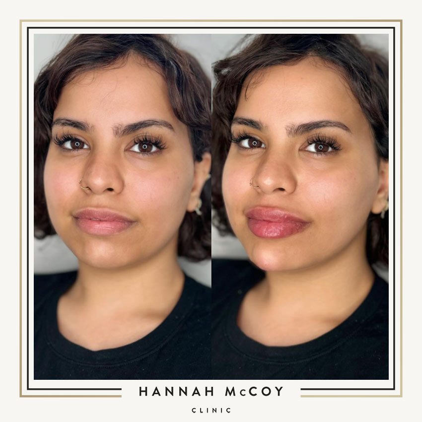 HOW TO REDUCE SWELLING AFTER LIP FILLER