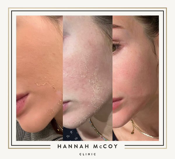 How Often Should You Get Microneedling