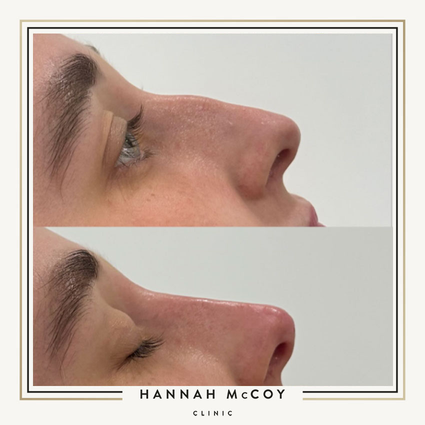 IS NOSE FILLER SAFE EVERYTHING YOU NEED TO KNOW