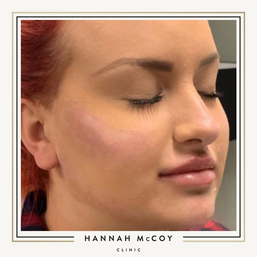 Is Cheek Filler Right for You?