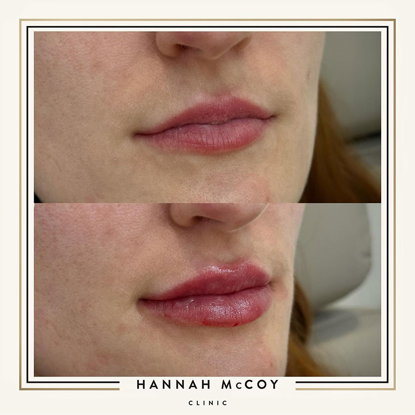 LIP FILLER SWELLING STAGES: WHAT TO EXPECT?