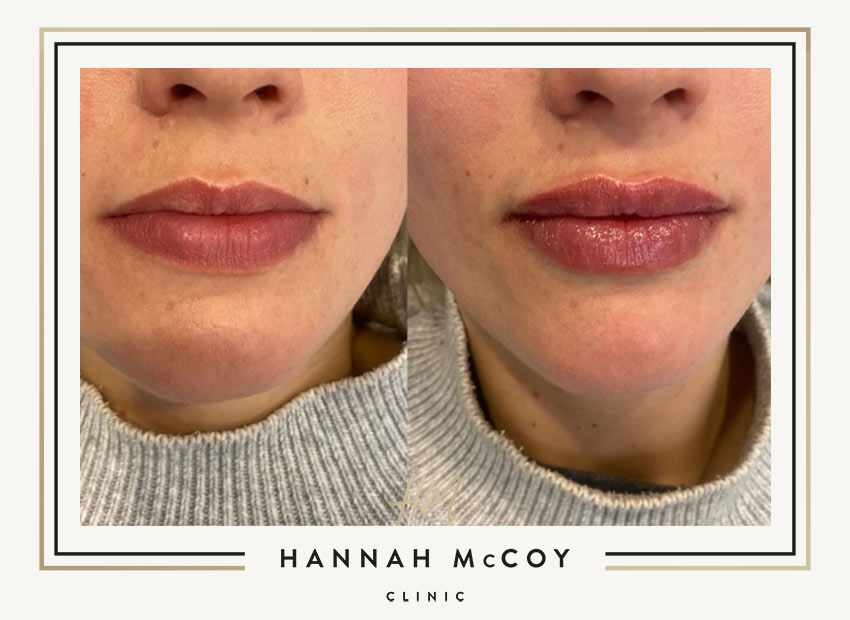 Lip Filler Final Results