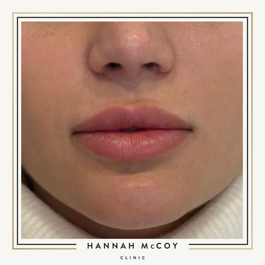 Lip Filler When Should You Be Concerned About The Swelling