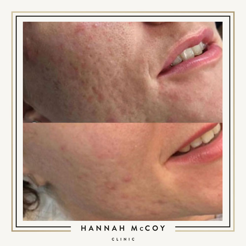 Microneedling Aesthetics Treatment