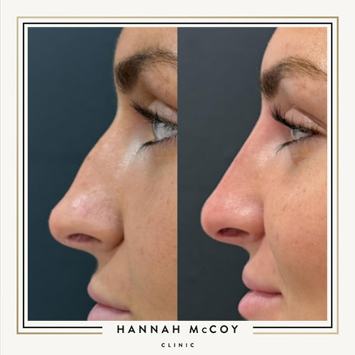 NOSE FILLER AFTERCARE 5 AFTERCARE TIPS TO FOLLOW