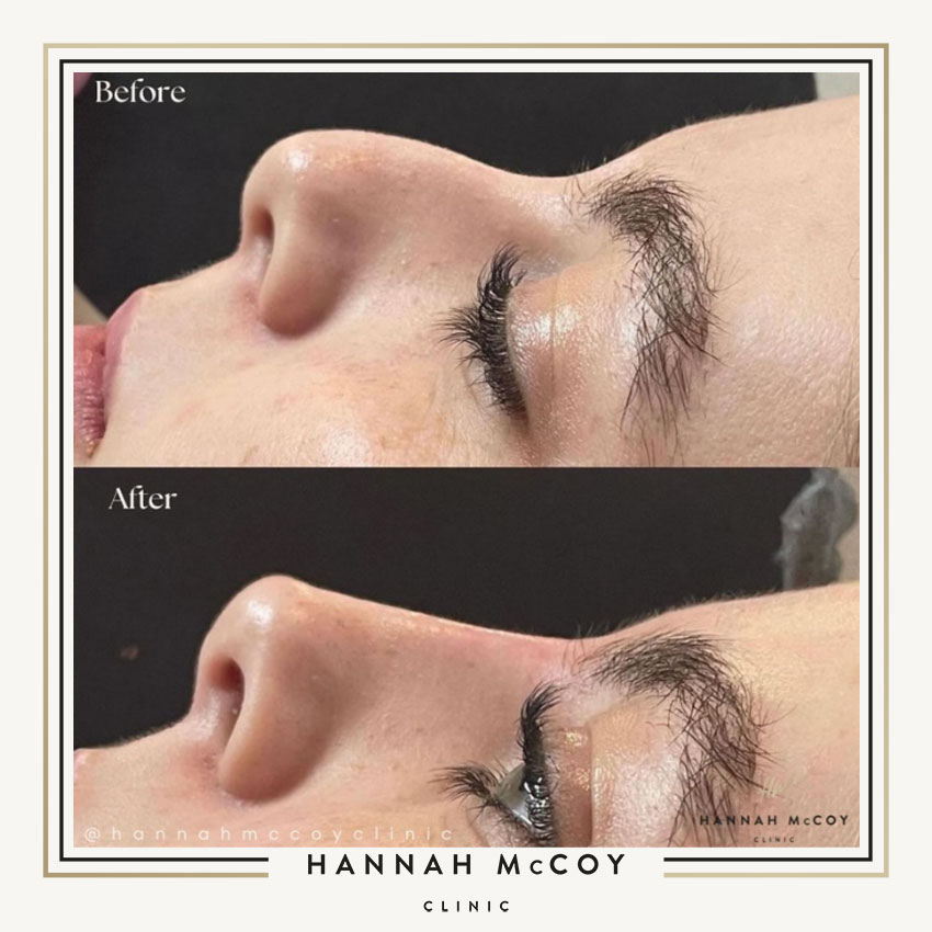 NOSE FILLER BEFORE AND AFTER