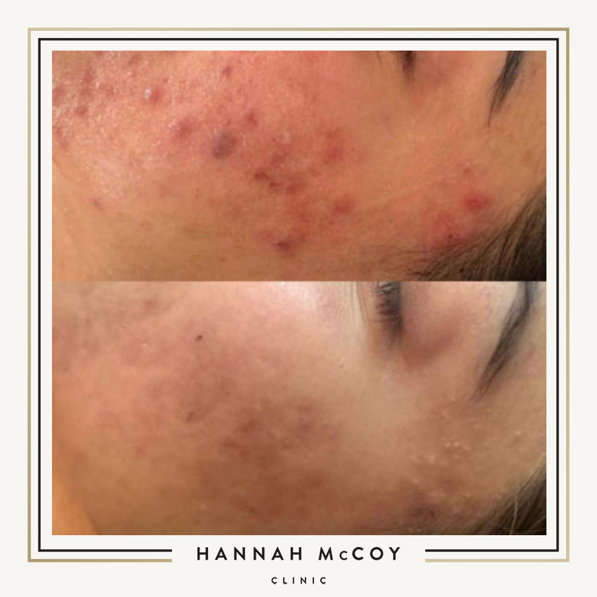 Skin Peels Aesthetics Treatment