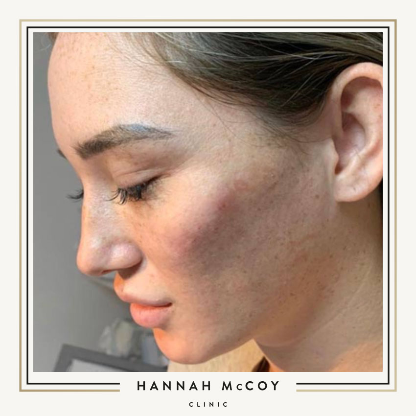 WHAT IS CHEEK ENHANCEMENT