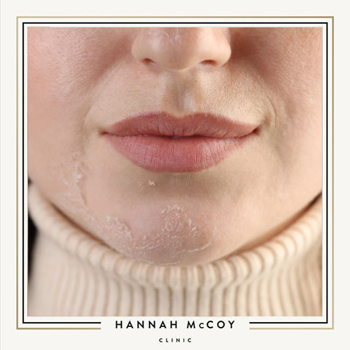 What Happens to Your Skin After a Chemical Peel