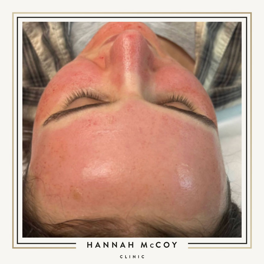 microneedling and Botox are very safe procedures