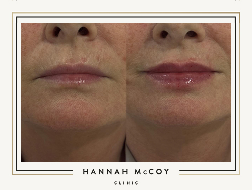 Lip Filler Aftercare